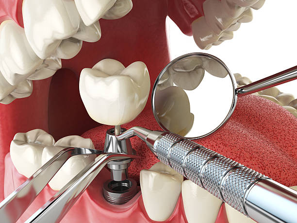 Best Emergency Dentist for Lost Fillings or Crowns in White Pine, TN